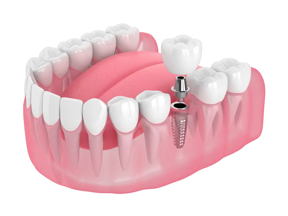3d render of jaw with dental implant Three parts of a dental implant: Implant post (body) into the bone, abutment and dental crown.