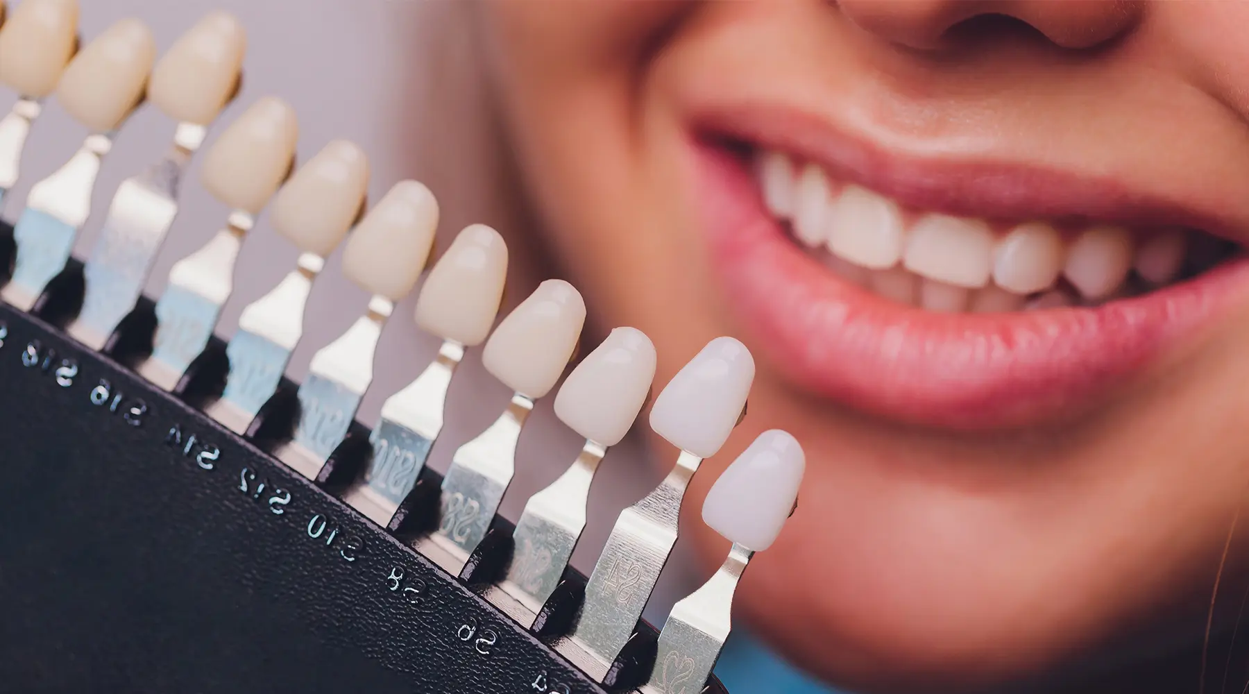 12 Questions About Dental Veneers Answered