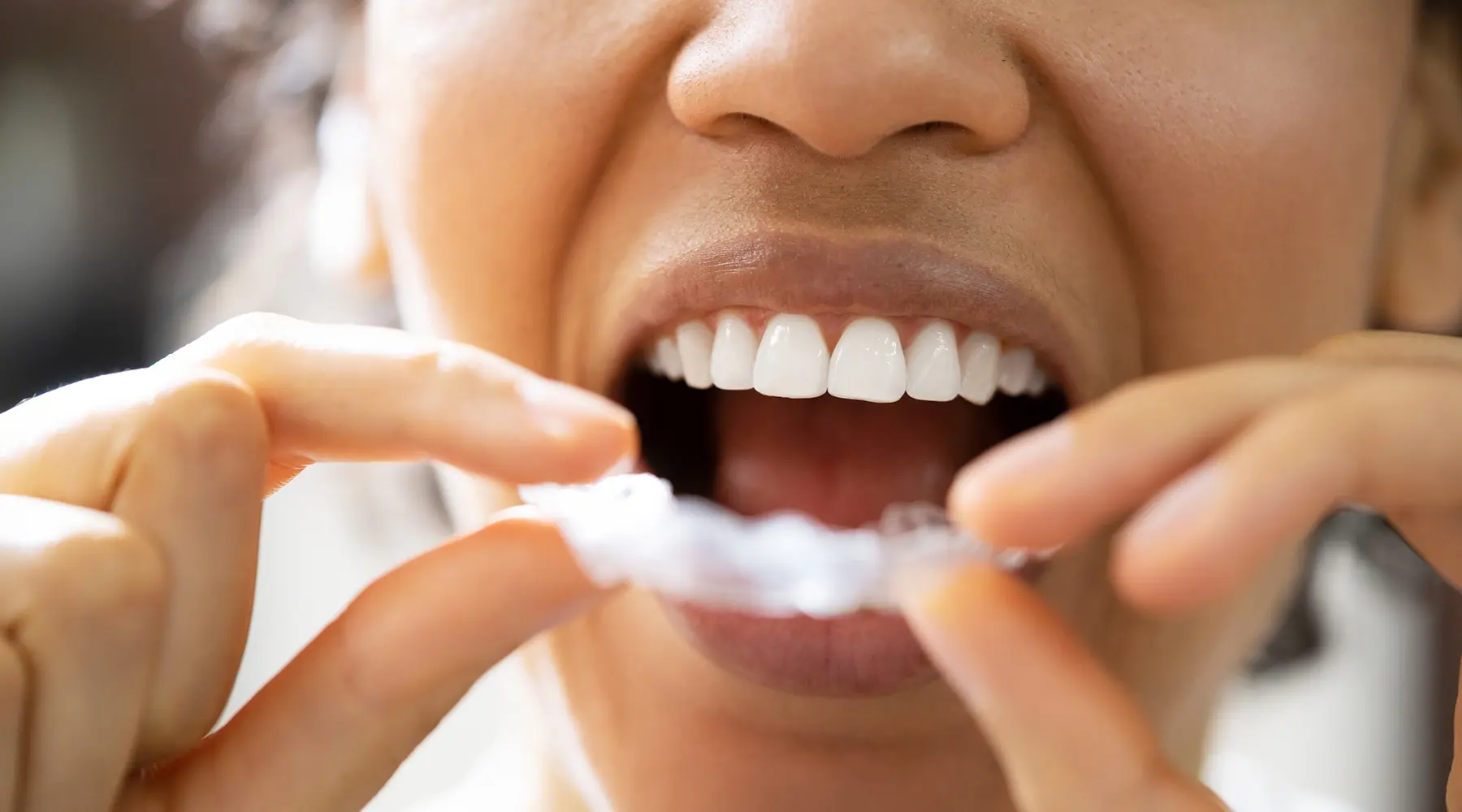 Night Guards and Bruxism: How to Protect Your Teeth from Grinding
