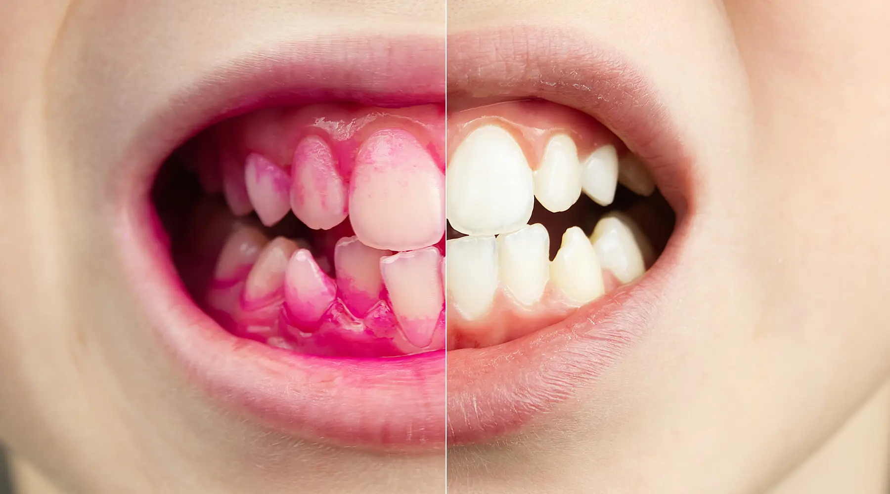 Plaque Disclosing Tablets: How They Help You Brush Better