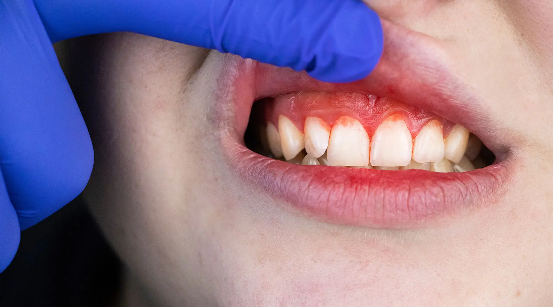 Can Gingivitis Cause Bumps on Gums?